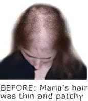 Female Genetic Hair Loss - Before