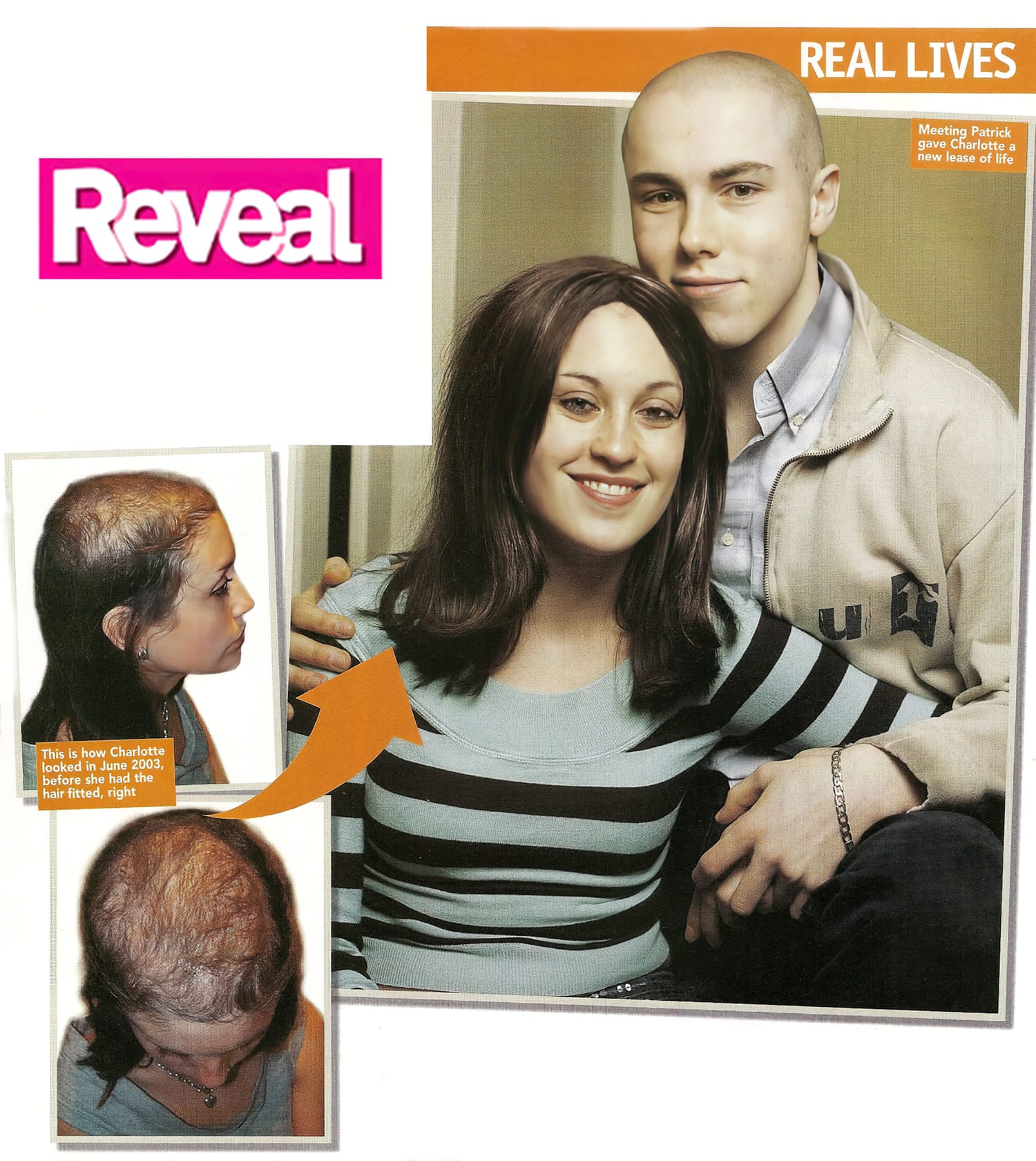 Trichotillomania - Before and After Mark Glenn's Kinsey System hair extensions - Reveal Magazine