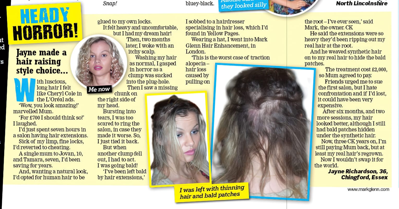 'Heady Horror' - Real Hair Extension Damage Saved by Mark Glenn - Real People Magazine